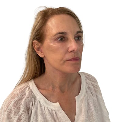Deep Neck Lift Before & After Gallery - Patient 206289 - Image 4