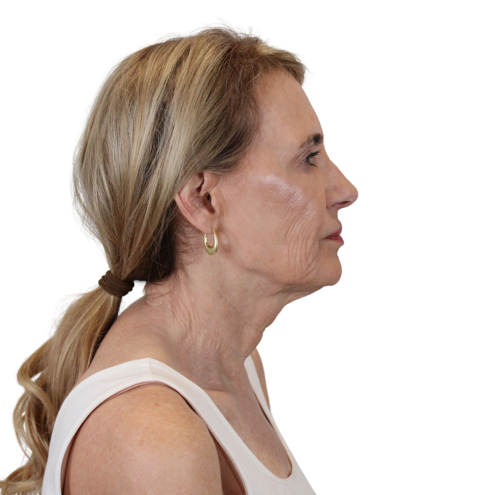 Deep Neck Lift Before & After Gallery - Patient 206289 - Image 5