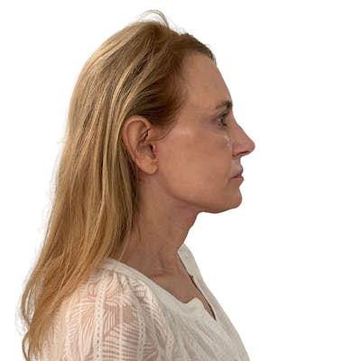 Deep Neck Lift Before & After Gallery - Patient 206289 - Image 6