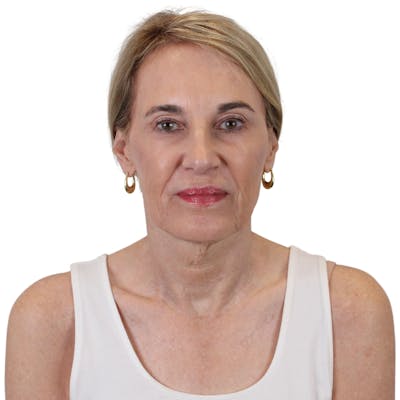 Deep Plane Facelift Before & After Gallery - Patient 195180 - Image 1