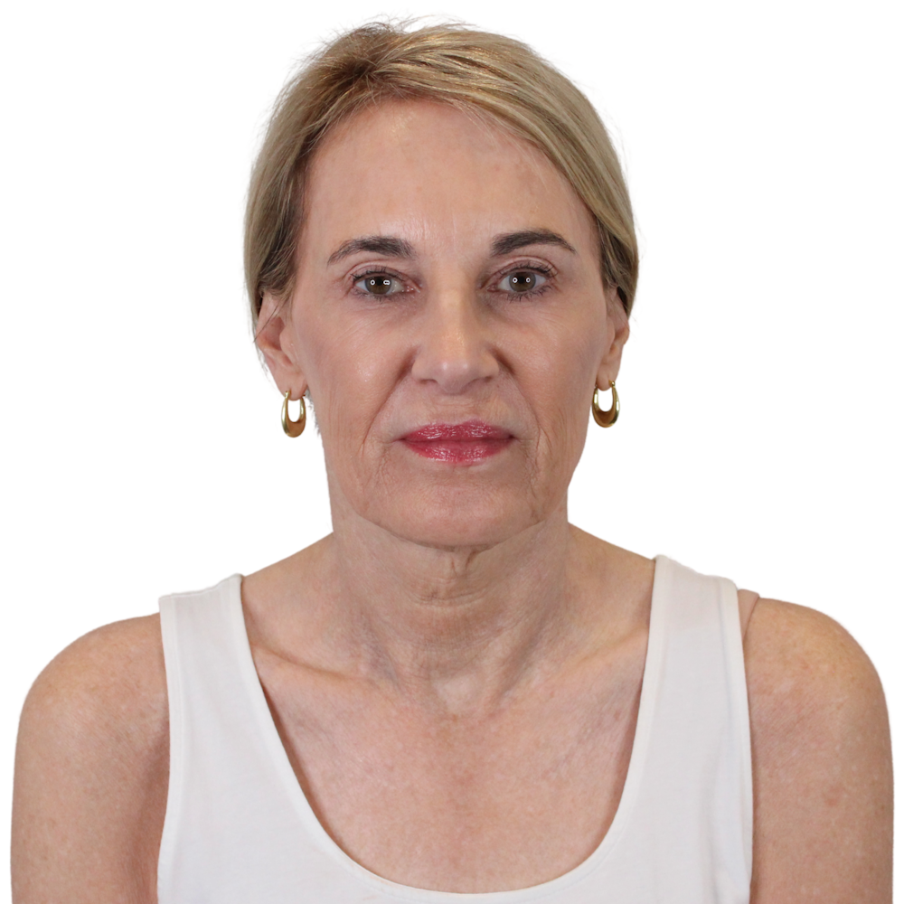 Deep Neck Lift Before & After Gallery - Patient 206289 - Image 1