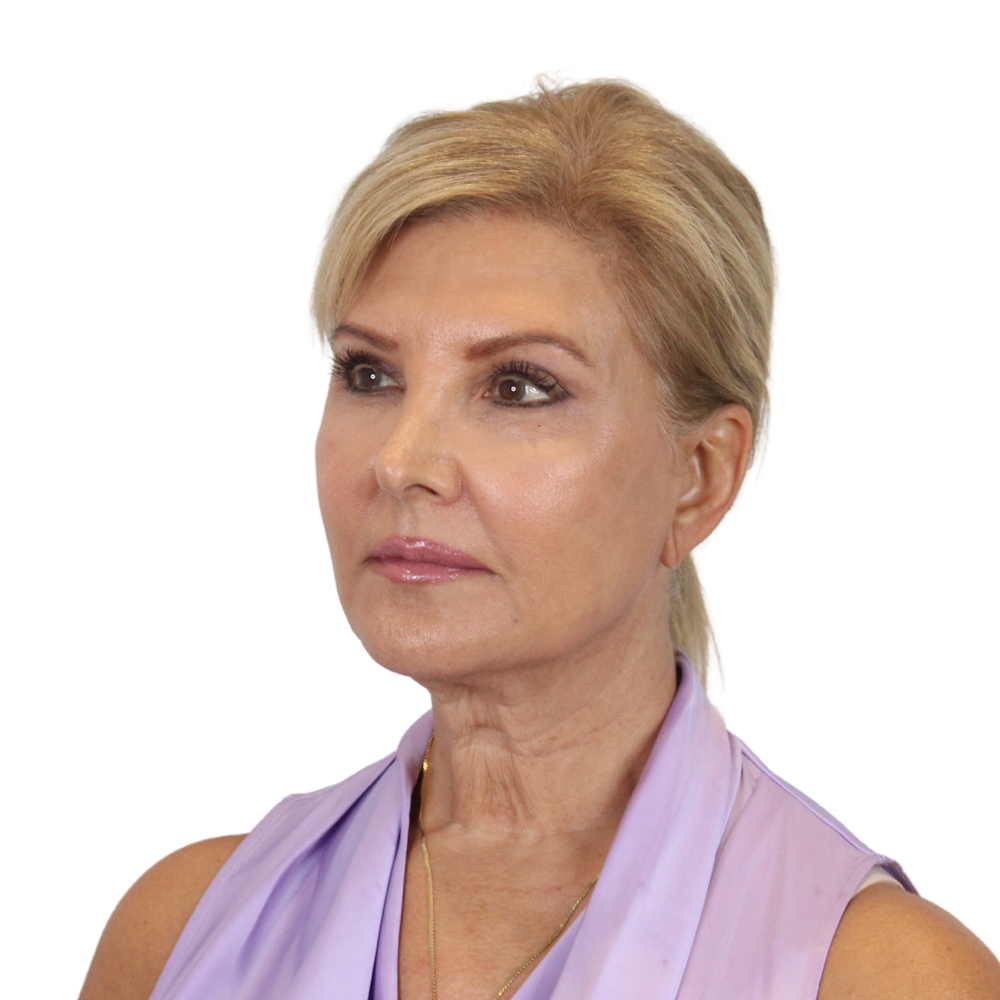 Deep Plane Facelift Before & After Gallery - Patient 935316 - Image 5