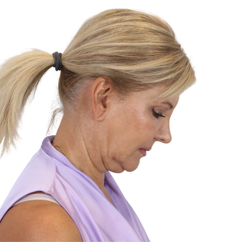 Deep Plane Facelift Before & After Gallery - Patient 935316 - Image 11