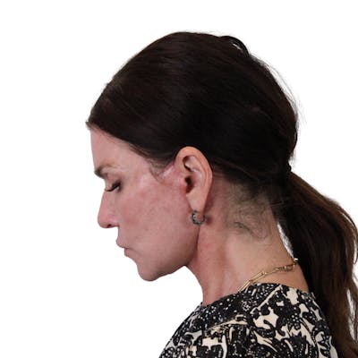 Deep Plane Facelift Before & After Gallery - Patient 422194 - Image 10