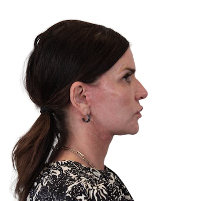 Deep Plane Facelift Before & After Gallery - Patient 422194 - Image 6