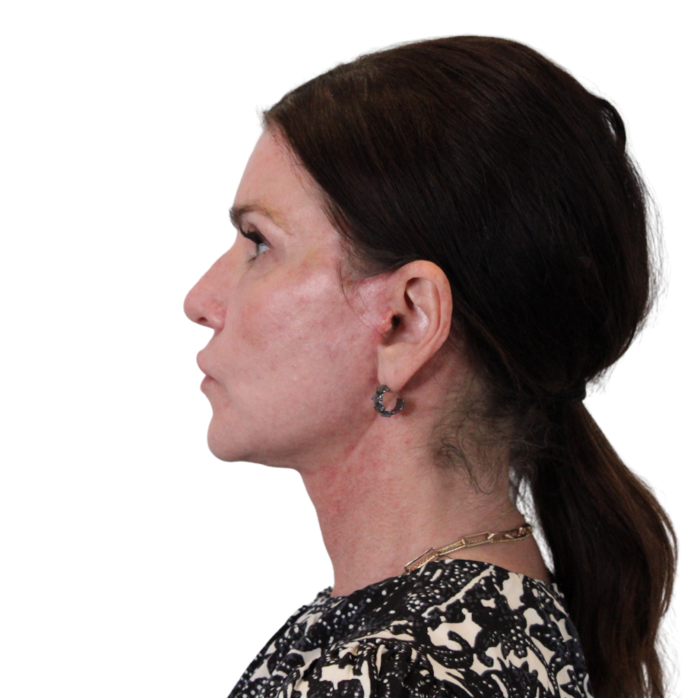 Deep Plane Facelift Before & After Gallery - Patient 422194 - Image 8