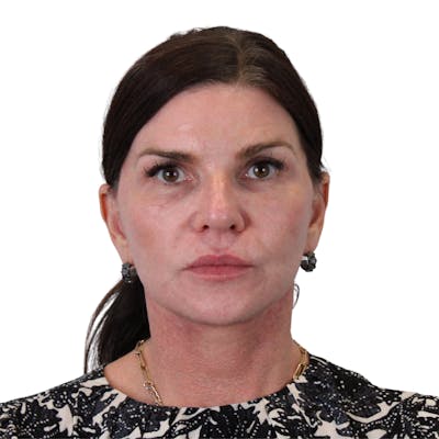 Deep Plane Facelift Before & After Gallery - Patient 422194 - Image 2