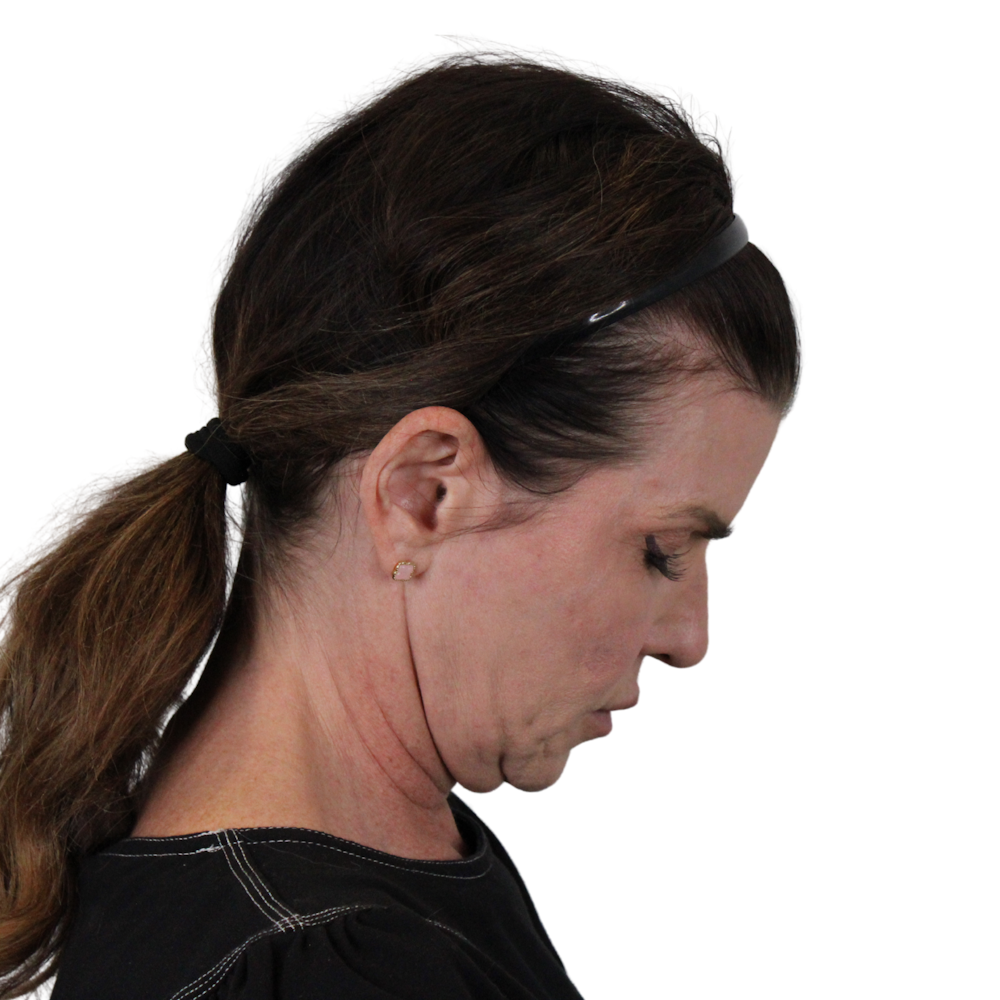 Deep Plane Facelift Before & After Gallery - Patient 422194 - Image 11