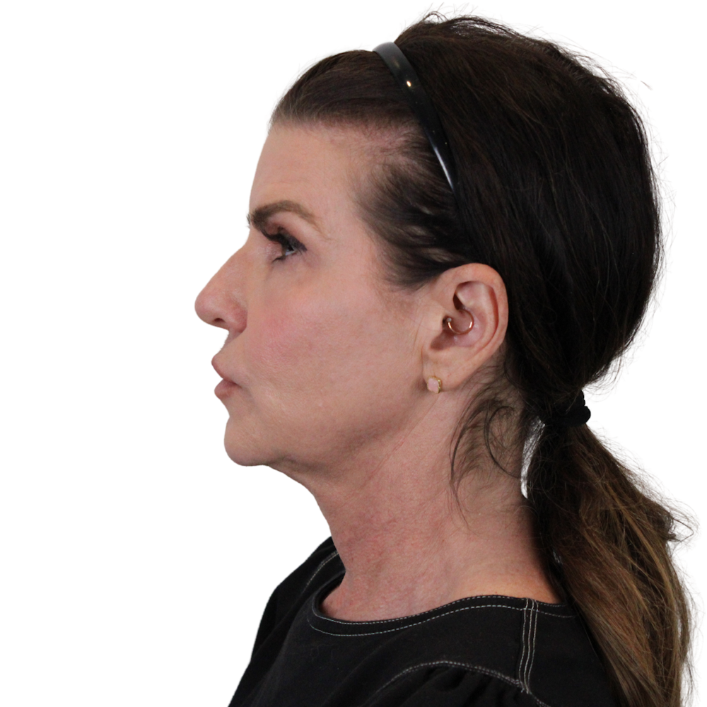 Deep Plane Facelift Before & After Gallery - Patient 422194 - Image 7