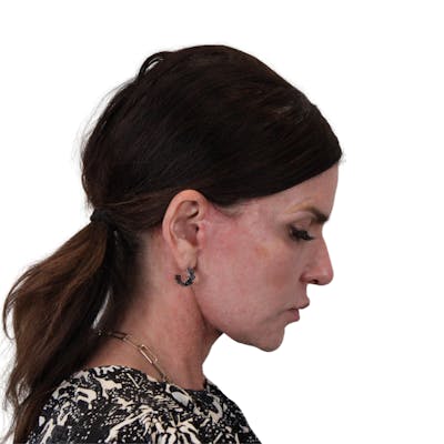 Deep Plane Facelift Before & After Gallery - Patient 422194 - Image 12