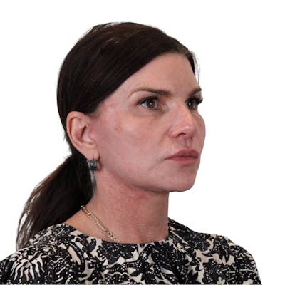 Deep Plane Facelift Before & After Gallery - Patient 422194 - Image 4