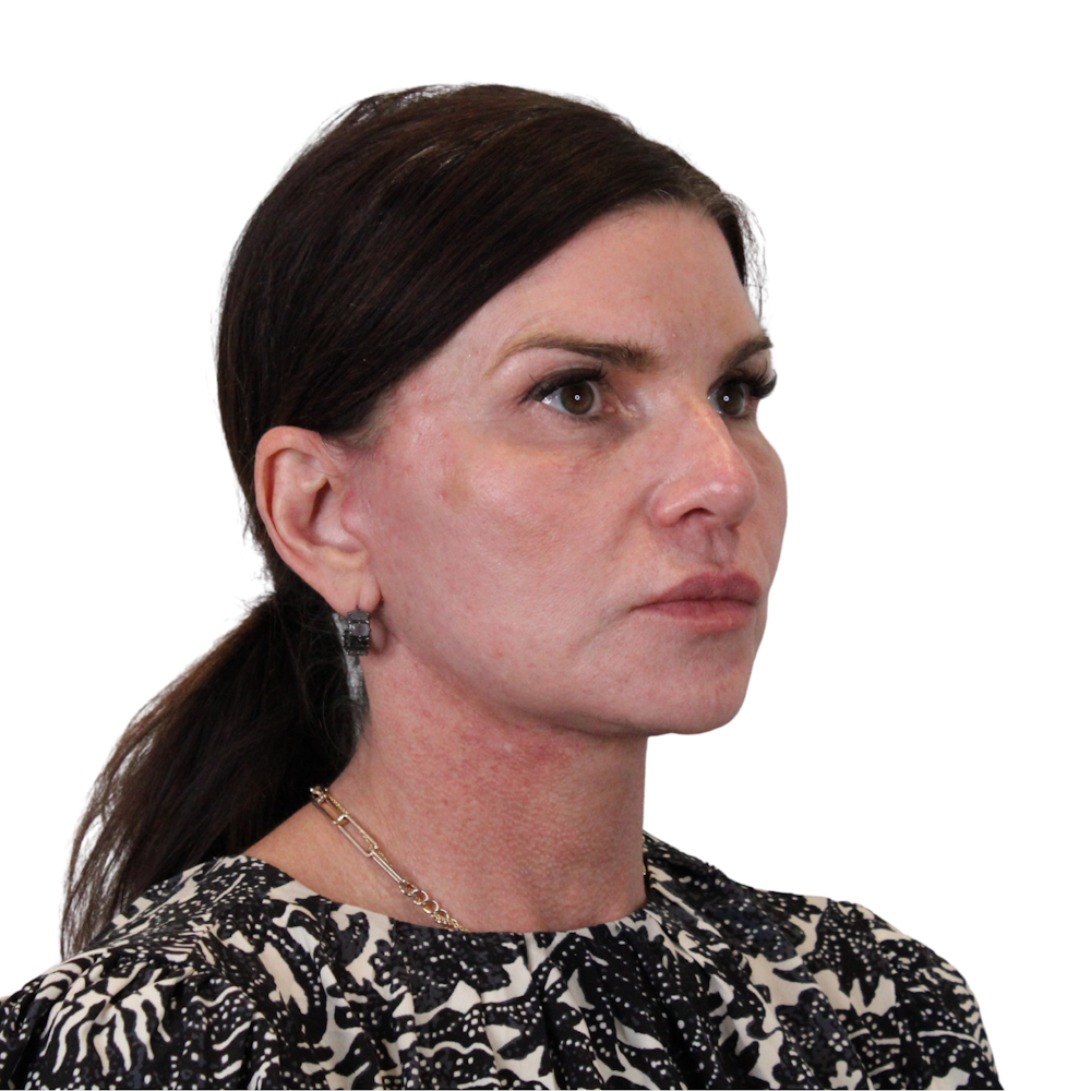 Deep Plane Facelift Before & After Gallery - Patient 422194 - Image 4