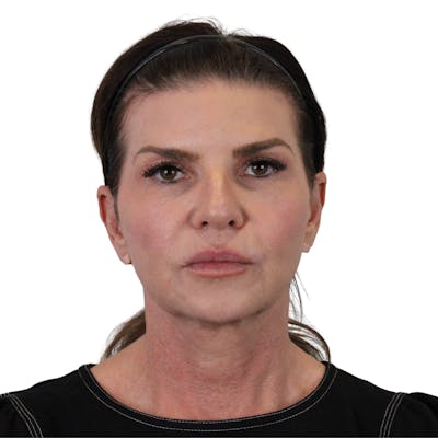 Deep Plane Facelift Before & After Gallery - Patient 422194 - Image 1
