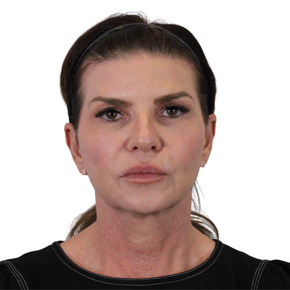 Deep Plane Facelift Before & After Gallery - Patient 422194 - Image 1