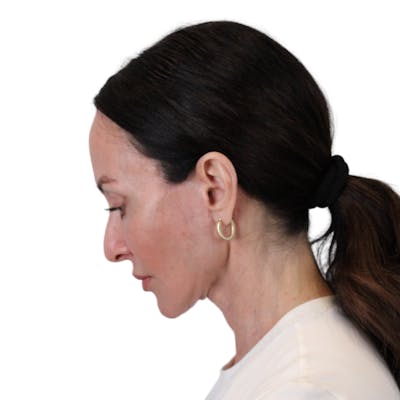 Deep Plane Facelift Before & After Gallery - Patient 507618 - Image 12