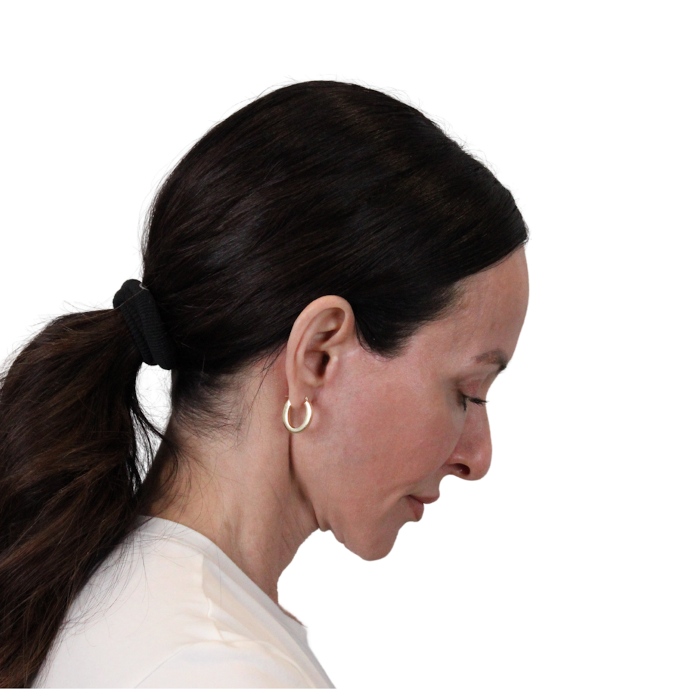 Deep Plane Facelift Before & After Gallery - Patient 507618 - Image 14
