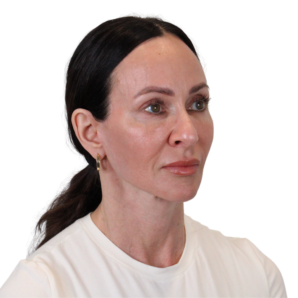 Deep Plane Facelift Before & After Gallery - Patient 507618 - Image 4