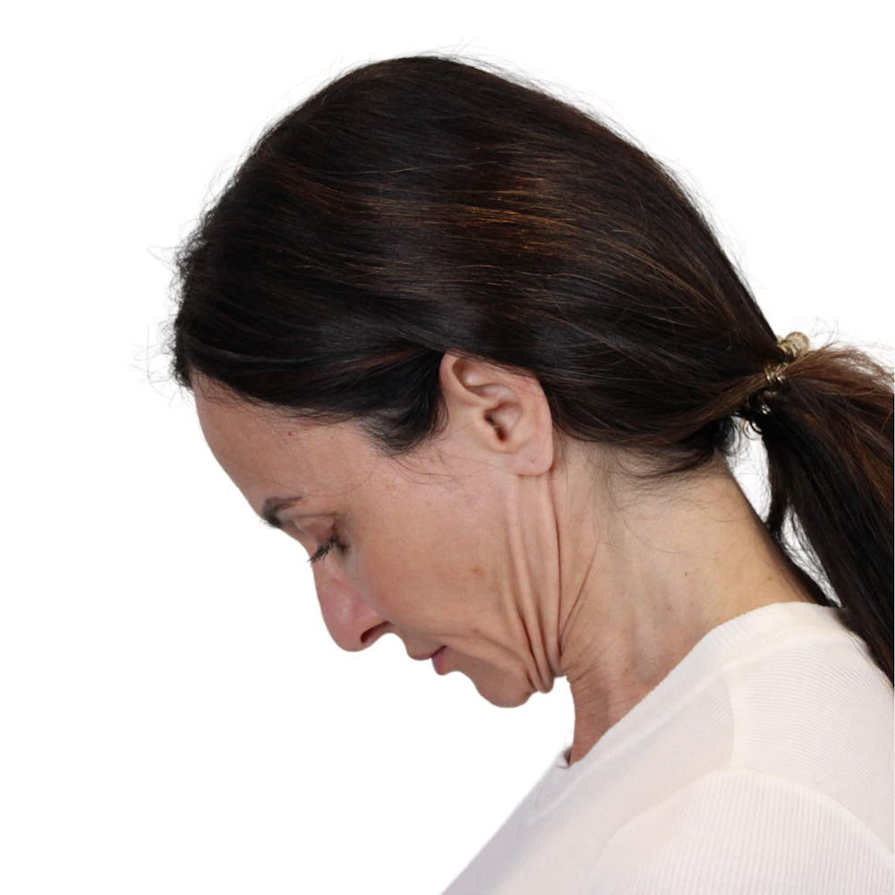 Deep Plane Facelift Before & After Gallery - Patient 507618 - Image 11