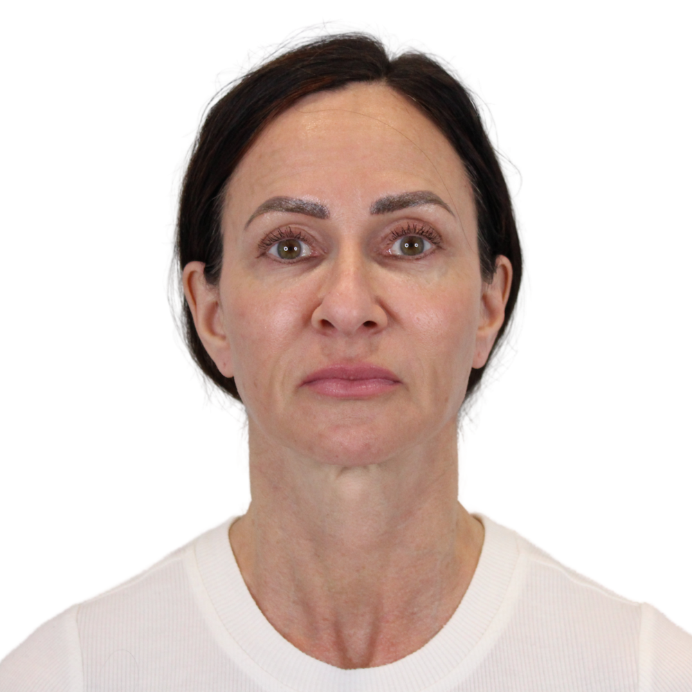 Deep Plane Facelift Before & After Gallery - Patient 507618 - Image 1