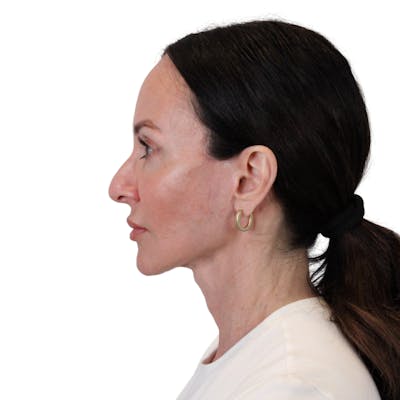 Deep Plane Facelift Before & After Gallery - Patient 507618 - Image 8