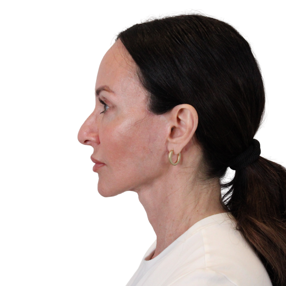 Deep Plane Facelift Before & After Gallery - Patient 507618 - Image 8