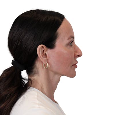 Deep Plane Facelift Before & After Gallery - Patient 507618 - Image 10