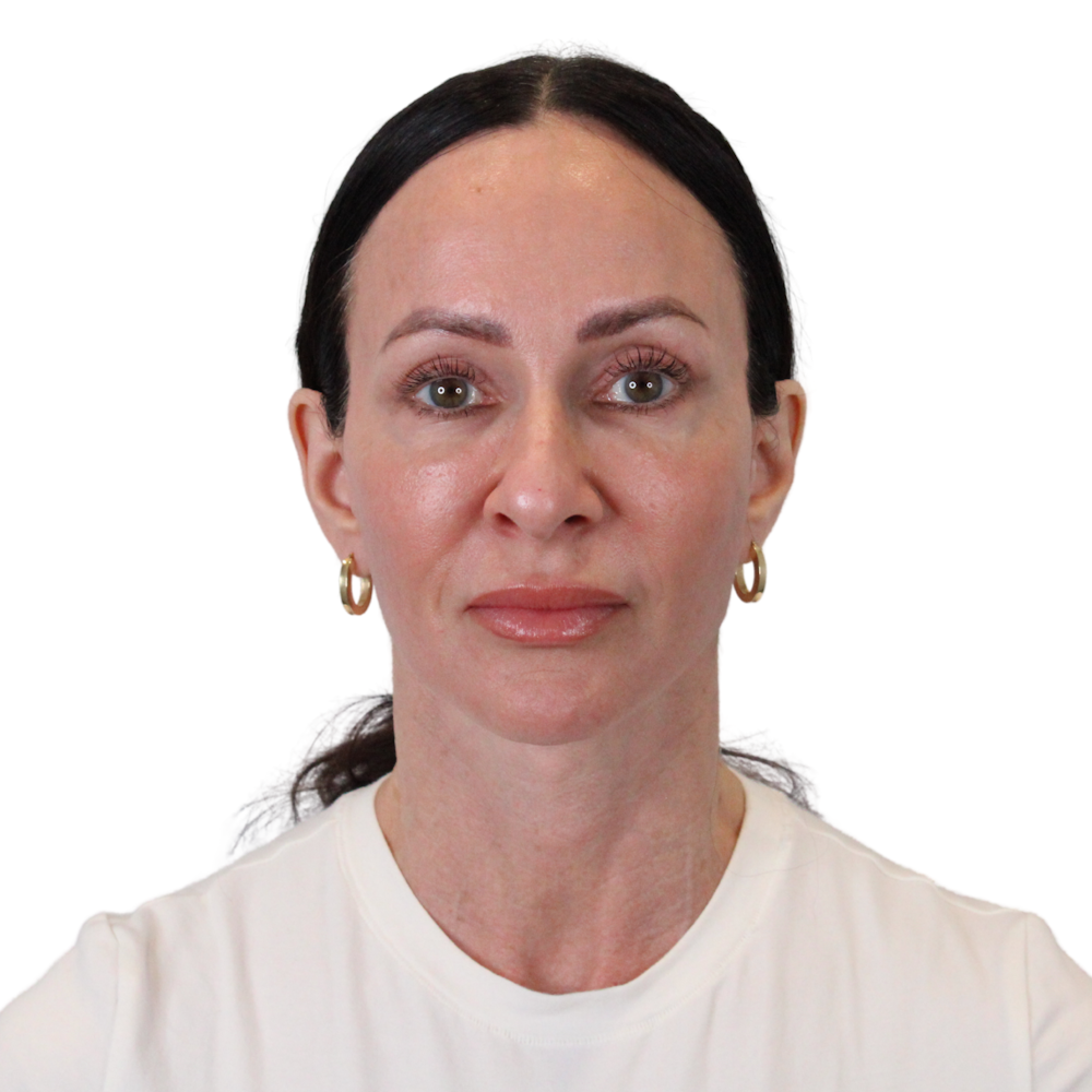 Deep Plane Facelift Before & After Gallery - Patient 507618 - Image 2