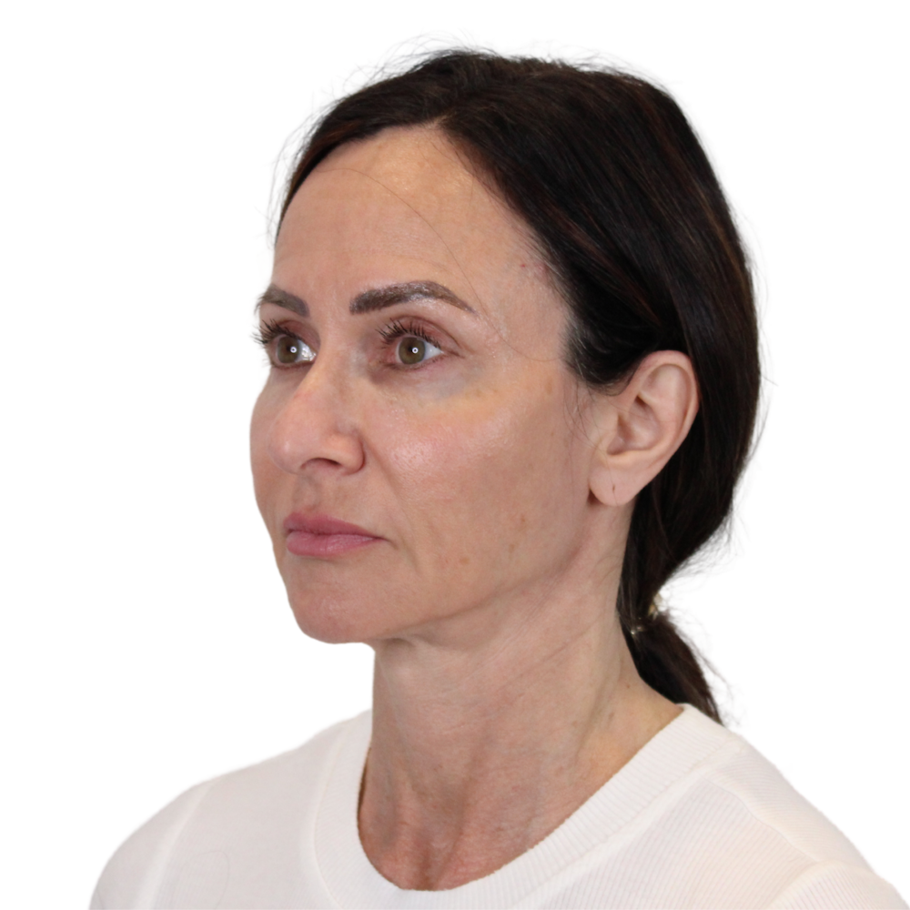 Deep Plane Facelift Before & After Gallery - Patient 507618 - Image 5