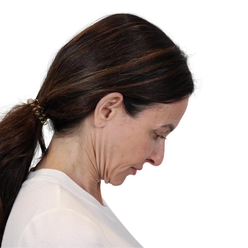 Deep Plane Facelift Before & After Gallery - Patient 507618 - Image 13