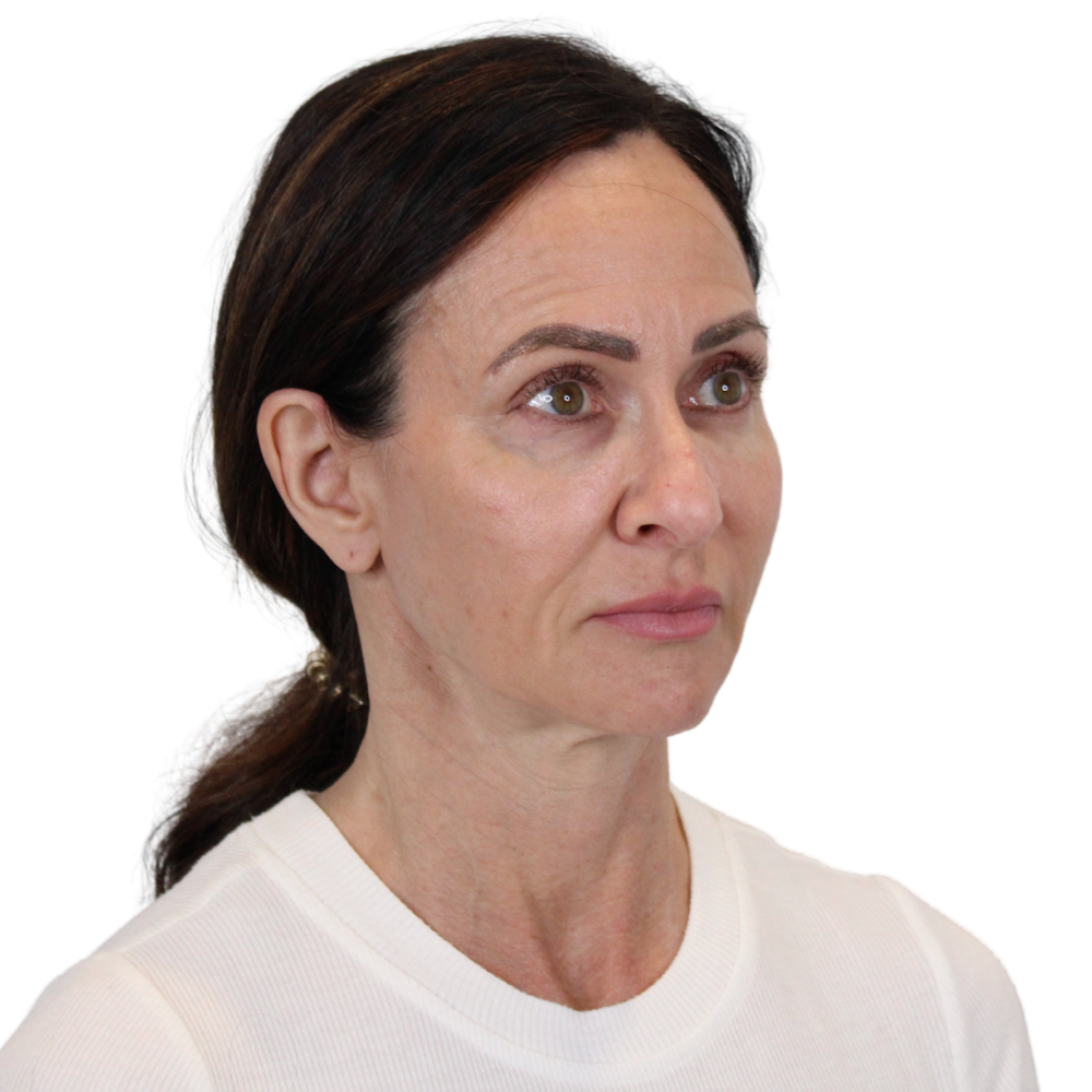 Deep Plane Facelift Before & After Gallery - Patient 507618 - Image 3