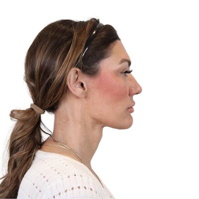 Deep Neck Lift Before & After Gallery - Patient 287864 - Image 6