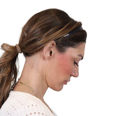 Deep Neck Lift Before & After Gallery - Patient 287864 - Image 8