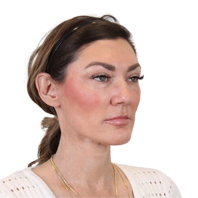 Deep Neck Lift Before & After Gallery - Patient 287864 - Image 4