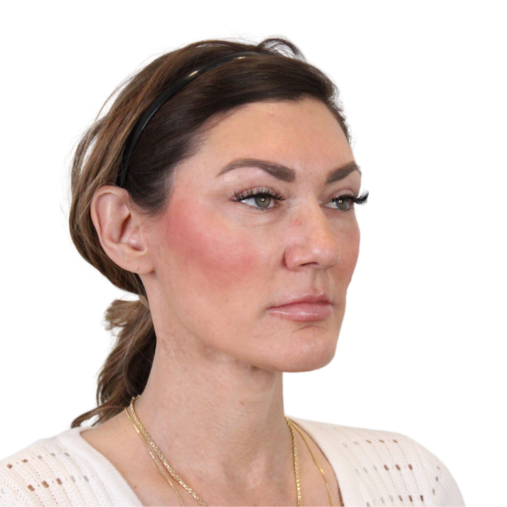 Deep Neck Lift Before & After Gallery - Patient 287864 - Image 4