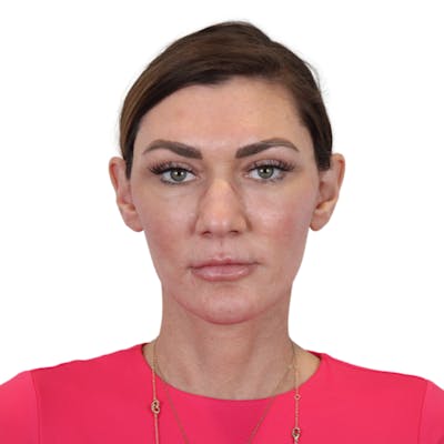 Deep Neck Lift Before & After Gallery - Patient 287864 - Image 2
