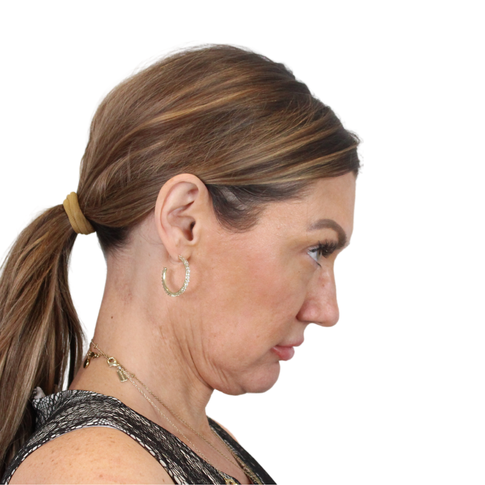 Deep Neck Lift Before & After Gallery - Patient 287864 - Image 7
