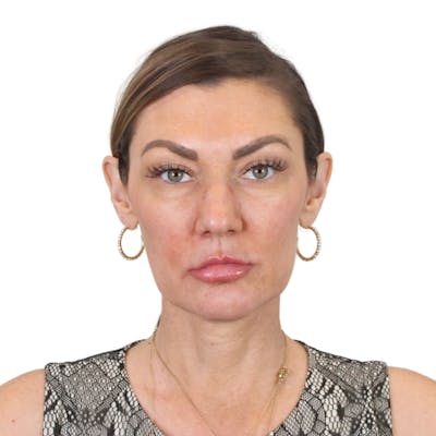 Deep Plane Facelift Before & After Gallery - Patient 370284 - Image 1