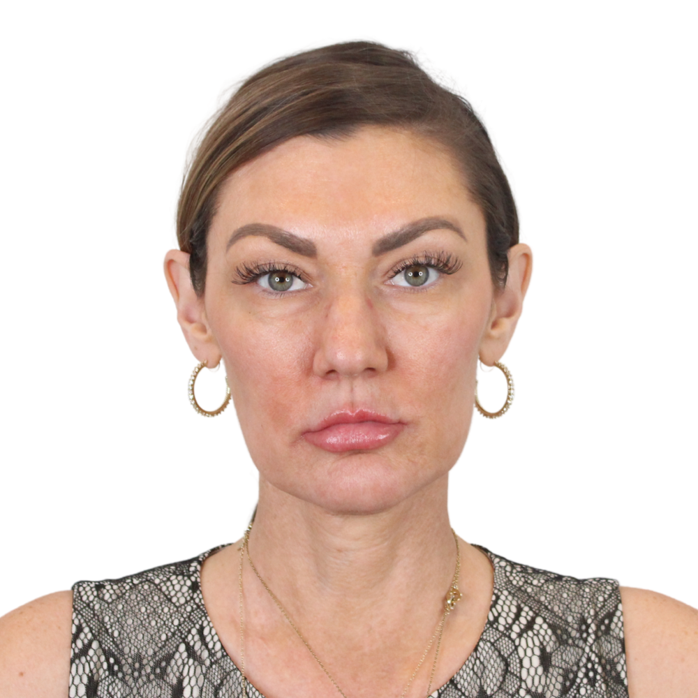 Deep Neck Lift Before & After Gallery - Patient 287864 - Image 1