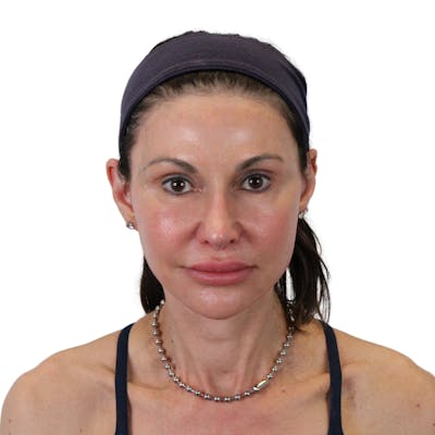 Deep Neck Lift Before & After Gallery - Patient 475712 - Image 2