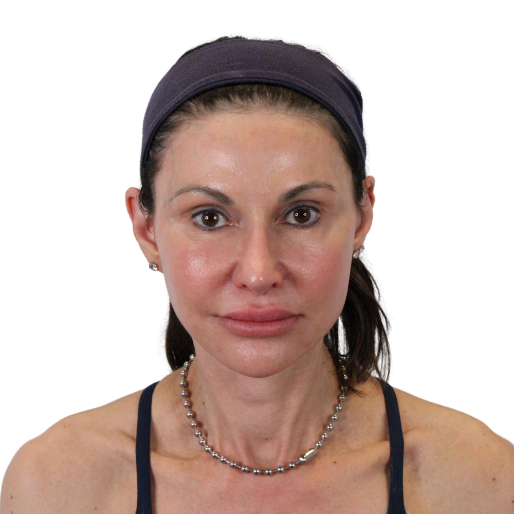 Deep Neck Lift Before & After Gallery - Patient 475712 - Image 2