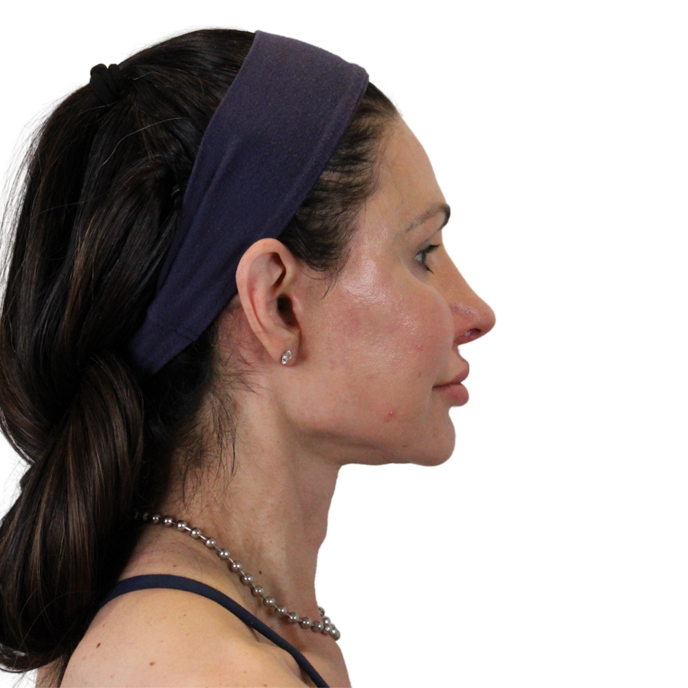 Deep Neck Lift Before & After Gallery - Patient 475712 - Image 4