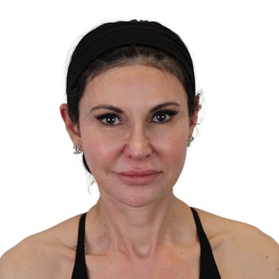 Deep Plane Facelift Before & After Gallery - Patient 271507 - Image 1