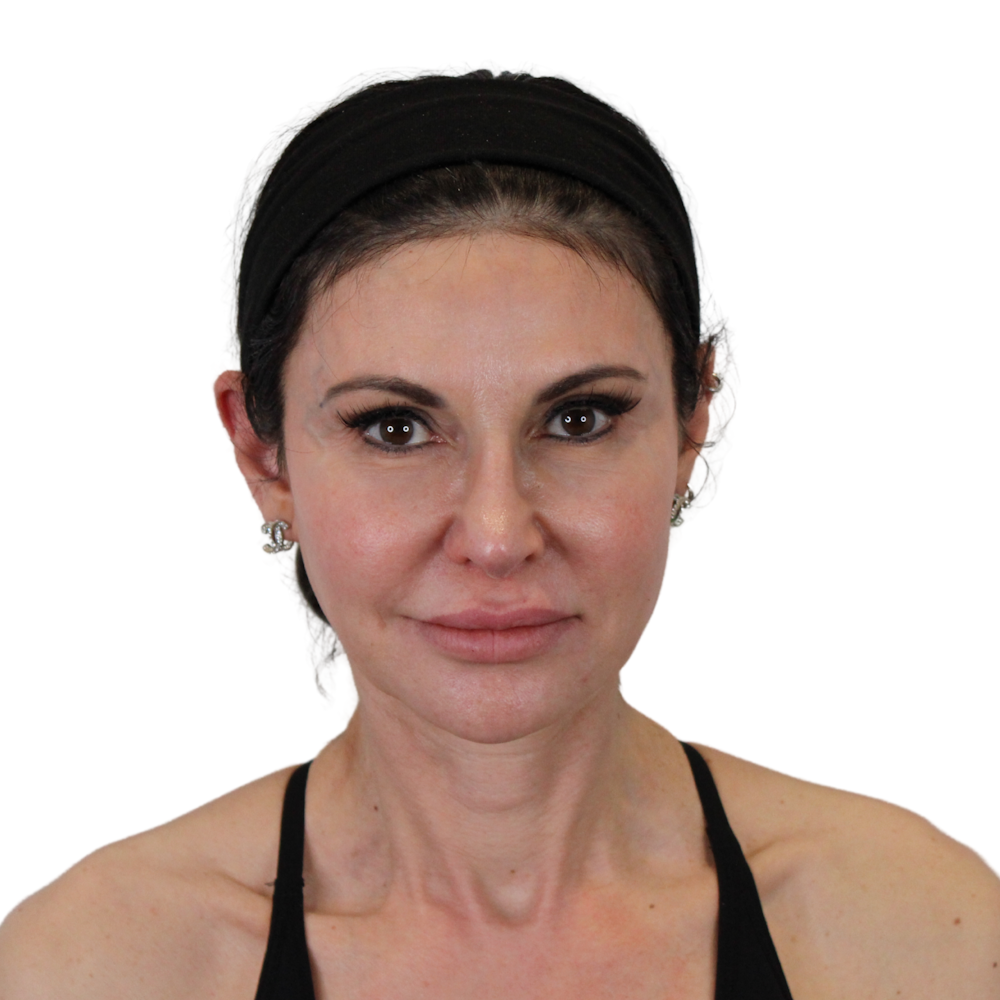 Deep Neck Lift Before & After Gallery - Patient 475712 - Image 1