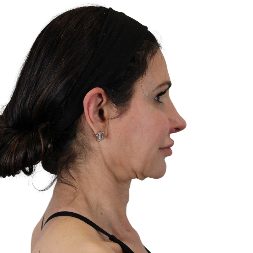 Deep Neck Lift Before & After Gallery - Patient 475712 - Image 3