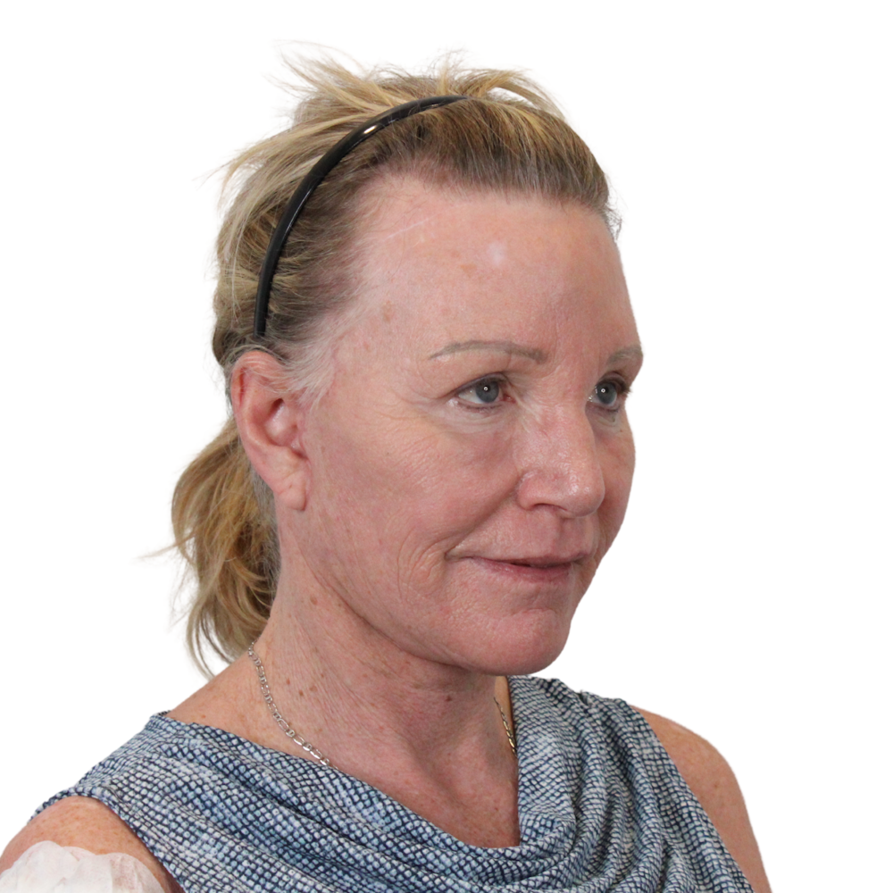 Deep Plane Facelift Before & After Gallery - Patient 428493 - Image 4