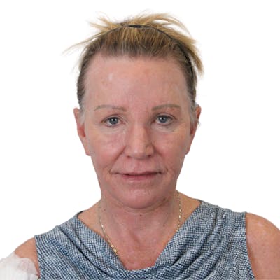 Deep Plane Facelift Before & After Gallery - Patient 428493 - Image 2