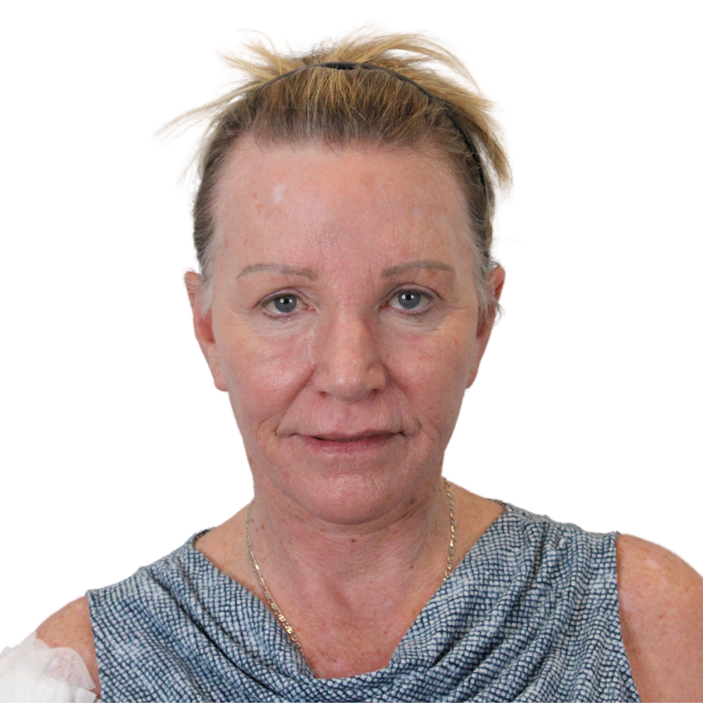 Deep Plane Facelift Before & After Gallery - Patient 428493 - Image 2