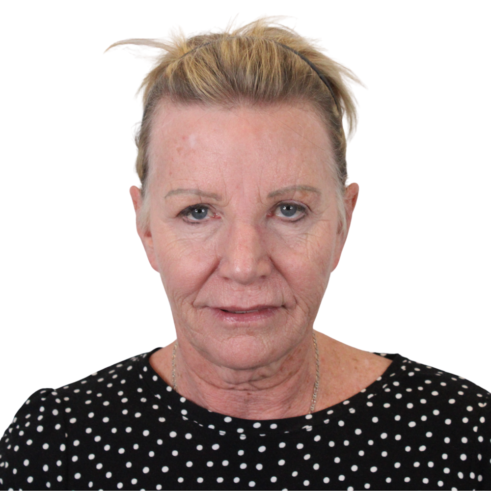 Deep Plane Facelift Before & After Gallery - Patient 428493 - Image 1