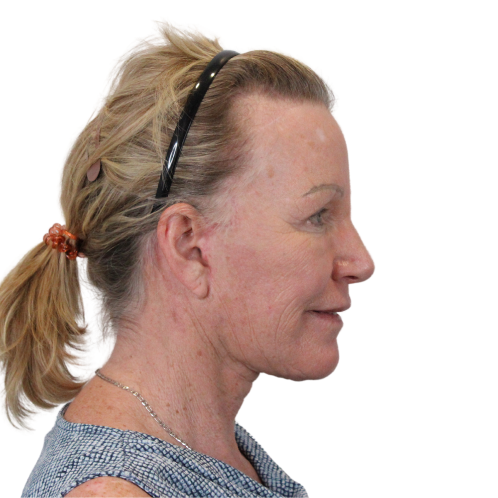 Deep Plane Facelift Before & After Gallery - Patient 428493 - Image 6