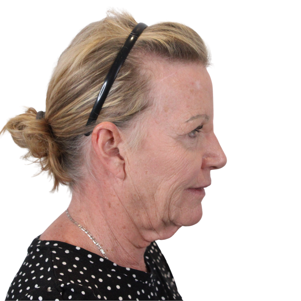 Deep Plane Facelift Before & After Gallery - Patient 428493 - Image 5
